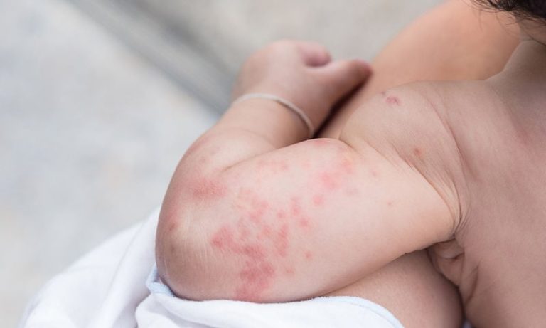 ΕΟΔΥ: Οκτώ τα κρούσματα ιλαράς στην Ελλάδα – Ανησυχία για αναζωπύρωση στην Ευρώπη